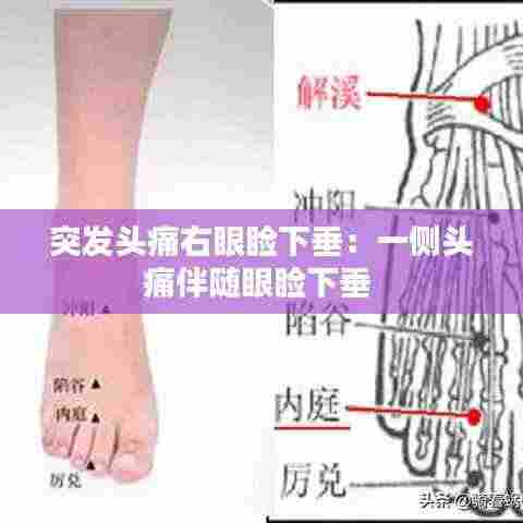 突发头痛右眼睑下垂:一侧头痛伴随眼睑下垂