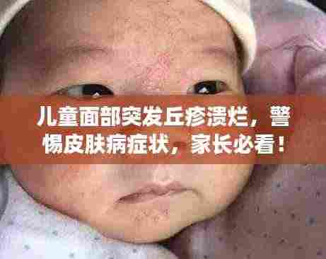 儿童面部突发丘疹溃烂，警惕皮肤病症状，家长必看！